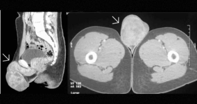 Rabdomiosarcoma embrionario inicia como masa escrotal indolora en paciente de 19 años