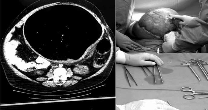 Manejo quirúrgico de shock séptico: control de fibrilación auricular intraoperatoria con Landiolol