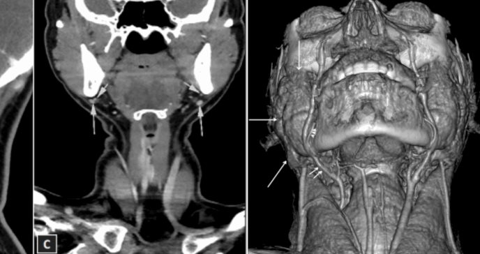 Detectan ausencia bilateral de glándulas submandibulares en seguimiento por nódulo tiroideo