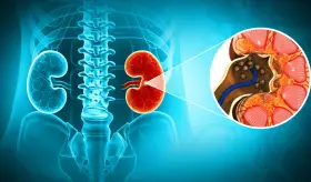 Dosis más altas de tiazida reducen el riesgo de cálculos renales: estudio