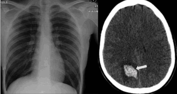 Paciente sufre hemorragia transcraneal como manifestación extrapulmonar de COVID-19