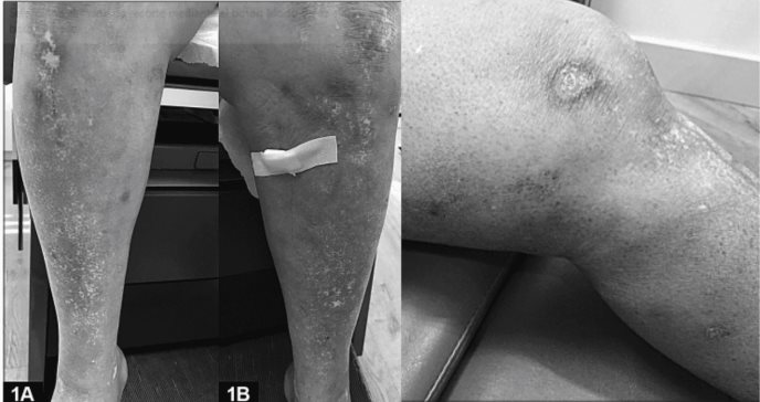 Diagnostican esclerodermia localizada profunda en paciente de enfermedad renal crónica