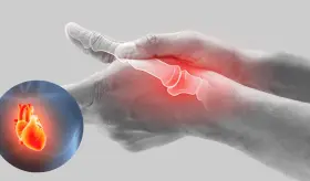 La artritis reumatoide incrementa el riesgo de ictus en pacientes con fibrilación atrial