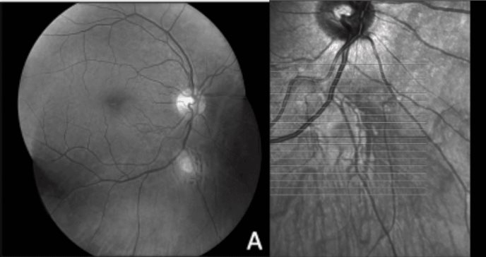 Detectan calcificación esclerocoroidea mediante angiografía por tomografía de coherencia óptica