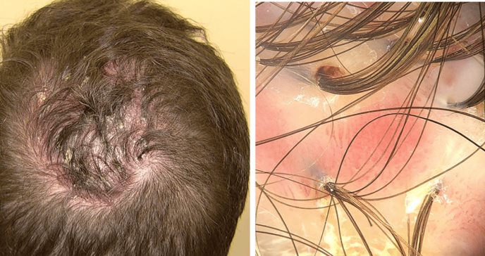 La metformina demostró eficacia en el tratamiento de la alopecia cicatricial centrífuga central