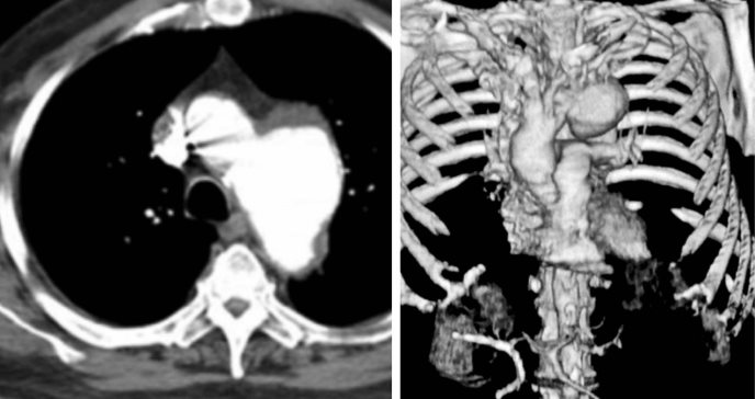 Aneurisma del arco aórtico causa parálisis de cuerda vocal izquierda en paciente diabético e hipertenso