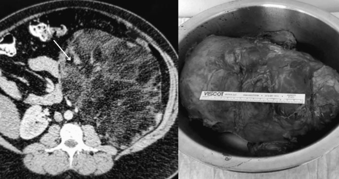 Paciente de hiperplasia suprarrenal congénita desarrolla adenoma gigante de la glándula suprarrenal