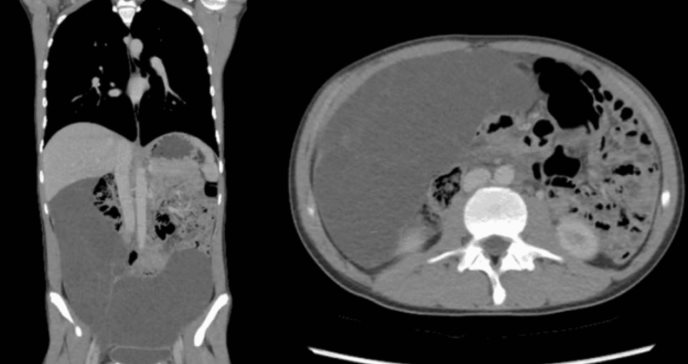 Mesotelioma peritoneal multiquístico benigno en un adolescente: caso extremadamente raro en varones