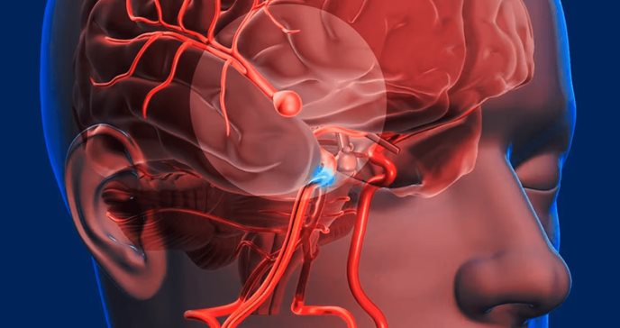 Incertidumbre sobre la anticoagulación en el accidente cerebrovascular embólico de origen indeterminado