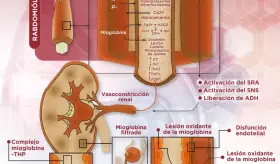 Mecanismos fisiopatológicos de la lesión renal aguda inducida por rabdomiólisis | Infografía