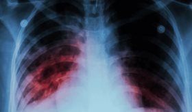 Hombre de 37 años sufre embolia pulmonar masiva en anestesia general durante laminectomía 
