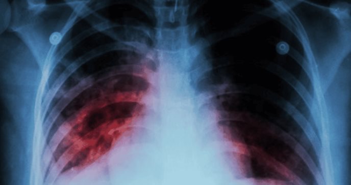 Hombre de 37 años sufre embolia pulmonar masiva en anestesia general durante laminectomía 