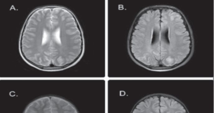 Menor sufre síndrome de encefalopatía reversible posterior tras trasplante alogénico por leucemia