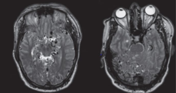 Detectan fístulas arteriovenosas durales en paciente de 39 años con cefaleas diarias progresivas 