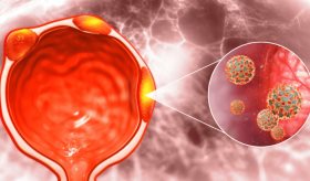 El cáncer de próstata en sus primeras etapas podría dejar de llamarse 'cáncer'