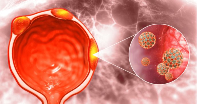 El cáncer de próstata en sus primeras etapas podría dejar de llamarse cáncer 