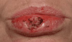 Decoloración, llagas persistentes y entumecimiento en los labios: posibles señales de cáncer labial
