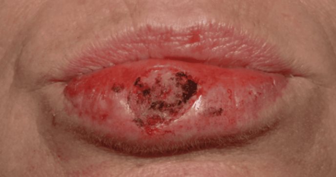 Decoloración, llagas persistentes y entumecimiento en los labios: posibles señales de cáncer labial