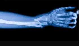 El litio podría proteger los huesos de los pacientes con trastorno bipolar 