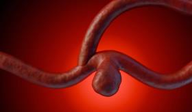 Investigadores logran utilizar robots diminutos para tratar aneurismas en modelos de laboratorio