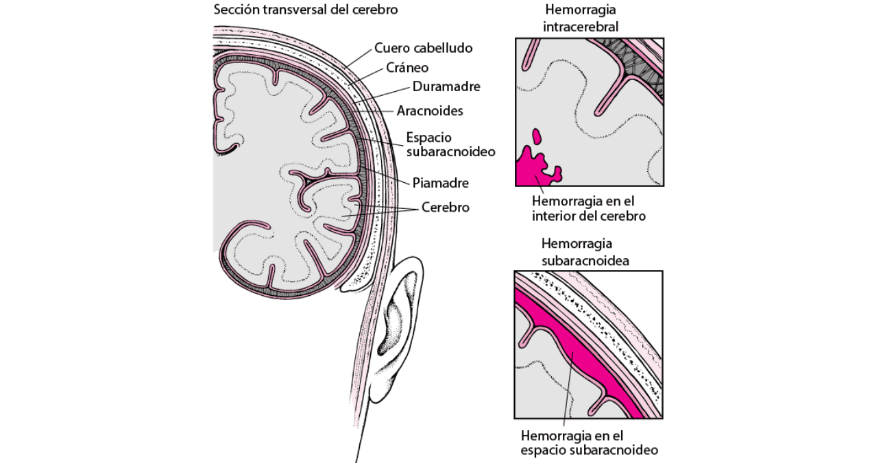 ¿Qué es una hemorragia subaracnoidea aguda?