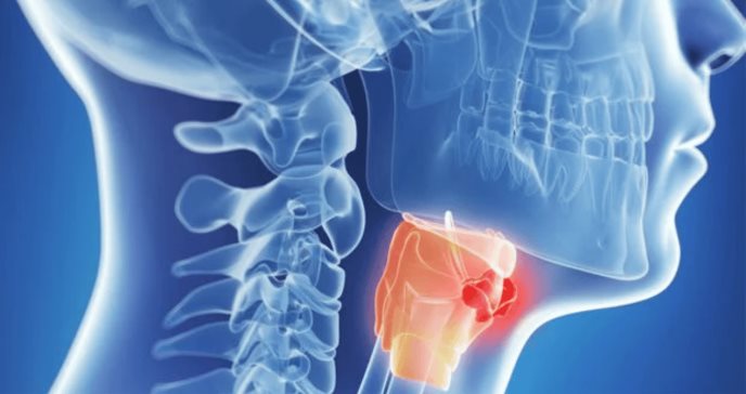 Descubren vínculo entre enfermedad periodontal y el riesgo de cáncer de cabeza y cuello