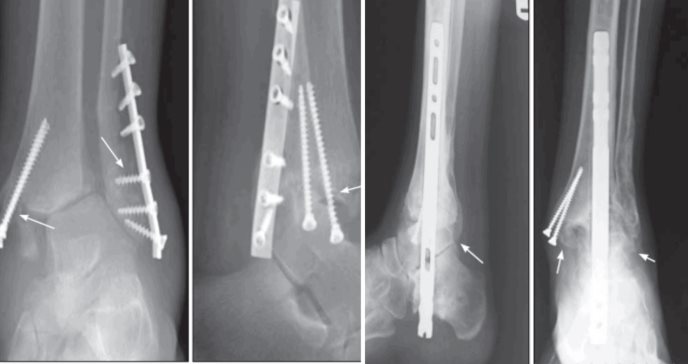 Describen fallo de una fijación de tobillo a causa de neuroartropatía de Charcot en paciente diabética 