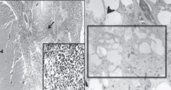 Carcinomatosis leptomeníngea como presentación inicial de cáncer metastásico diagnosticado en autopsia