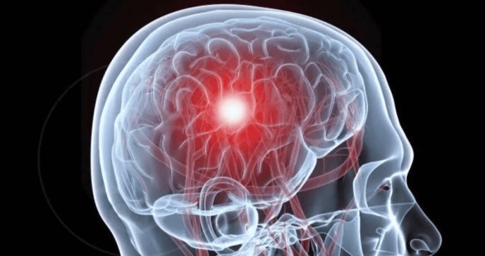 Desarrollan un modelo predictivo para la epilepsia tras trombosis de senos venosos cerebrales