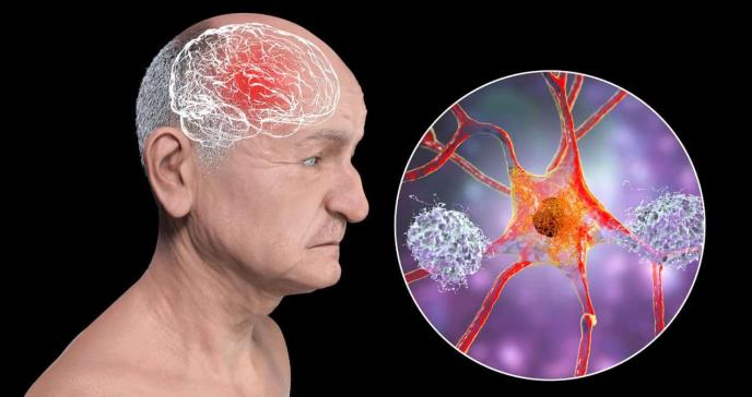 Estas son las enfermedades cardiovasculares que  se relacionan con el deterioro cognitivo y la demencia 