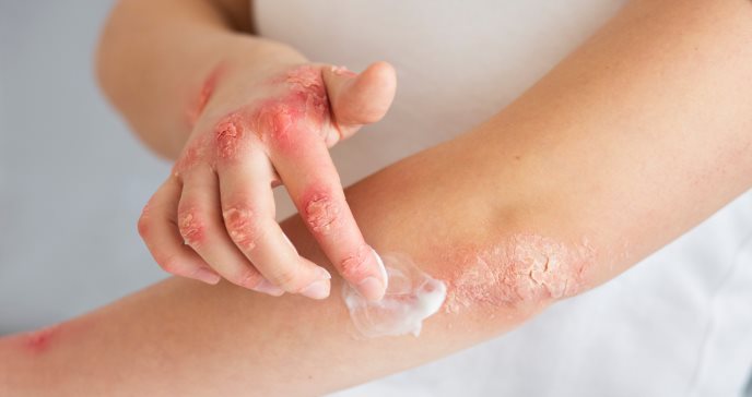 Picazón, dolor y piel enrojecida: síntomas de la dermatitis atópica