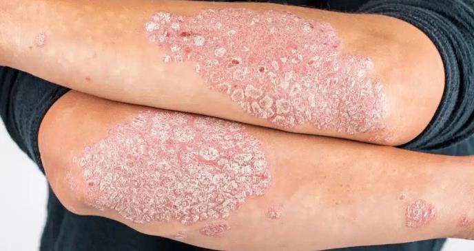 La psoriasis y la artritis psoriásica son enfermedades crónicas que afectan la piel y las articulaciones