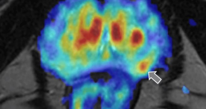 Inteligencia artificial podría predecir la curación, recurrencia y metástasis en el cáncer de próstata