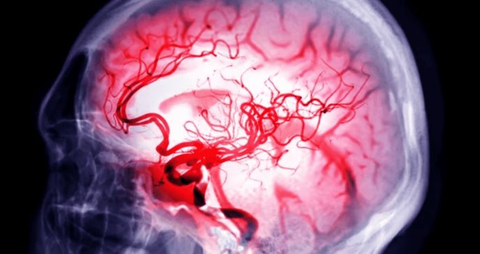 Apatía tras hemorragia intracerebral podría indicar aumento del riesgo de demencia y atrofia cerebral