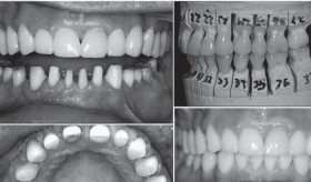 Pérdida dental no cariosa por factores erosivos, fue tratada con una reconstrucción total de la dentadura