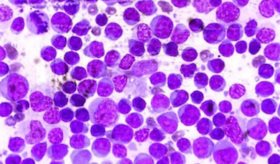 Alteraciones en la producción de células sanguíneas: Síndromes mielodisplásicos
