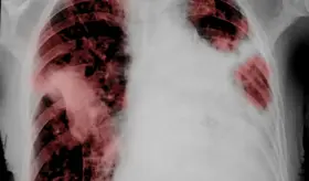 Tos persistente y falta de aire: Conozca las señales del cáncer de pulmón de células no pequeñas