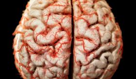 Para el año 2059 se espera un estimado de 150 millones de personas con Alzheimer