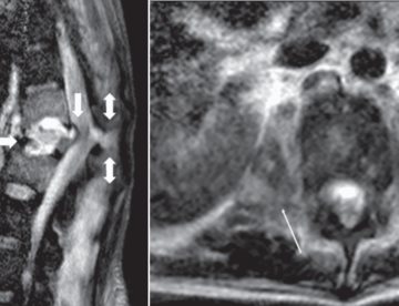 Hombre con fracturas e infección vertebral desarrolla bacteria resistente a la mayoría de antibióticos