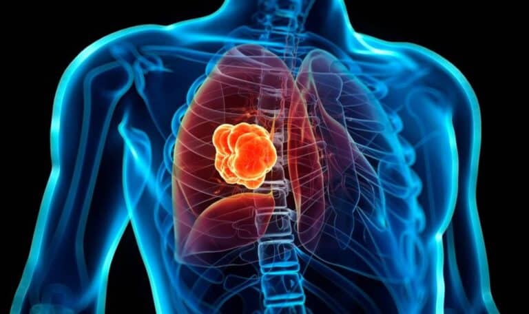 Nueva tecnología permite detectar el cáncer de pulmón a través del aliento
