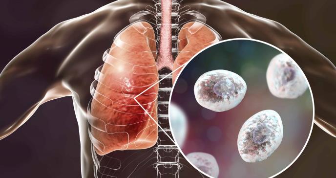 ¿Qué es la Pneumocystis? ¿Qué población se ve más afectada?