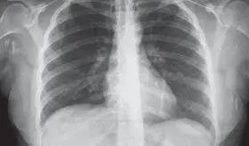 Detectan cáncer de pulmón en estadio 2 completamente asintomático 
