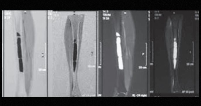 Describen manejo quirúrgico de displasia fibrosa bilateral tratado con clavo intramedular de tibia