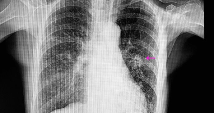 Tuberculosis y neumonía: ¿Por qué no son lo mismo y cómo puede diferenciarlas?