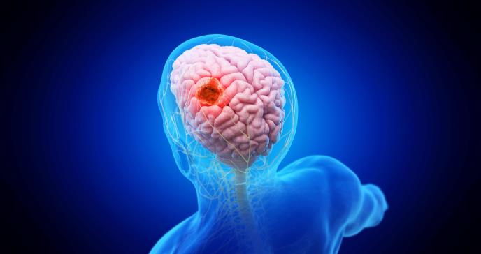 Nueva terapia muestra avances en la supervivencia de pacientes con cáncer cerebral de baja supervivencia