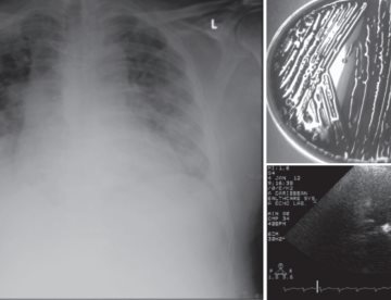 Tríada de Osler:  paciente de 65 años presenta endocarditis, meningitis y neumonía progresiva casi letal