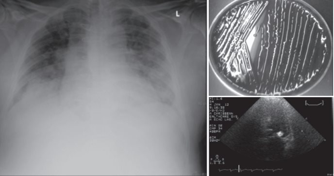 Tríada de Osler:  paciente de 65 años presenta endocarditis, meningitis y neumonía progresiva casi letal