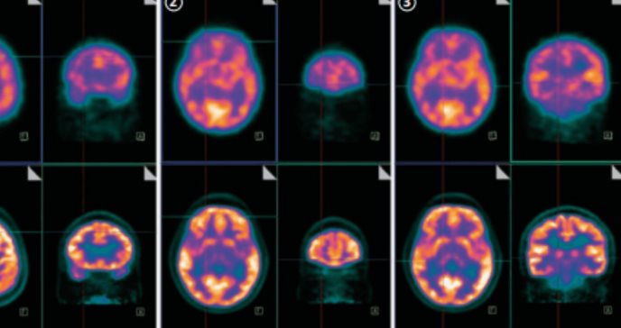 Lesiones cerebrales desencadenan problemas de memoria y alteraciones conductuales en veterano de 30 años