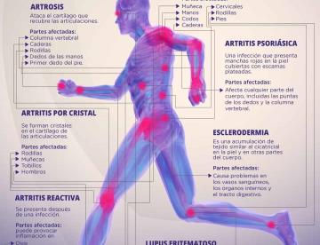 PARTES DEL CUERPO AFECTADAS POR LA ARTRITIS