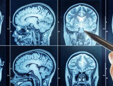 Avance en la neurocirugía: Nueva técnica revoluciona el tratamiento de hematomas y hemorragias cerebrales